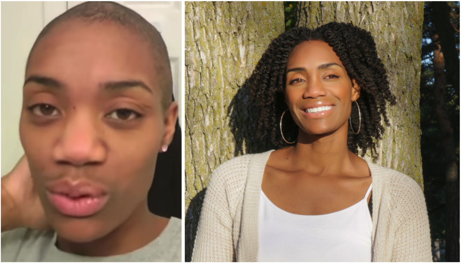 Jassica Langley Before And After Alopecia Free jassica-langley-before-and-after-alopecia-free
