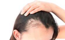 How To Fix Traction Alopecia